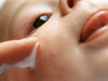 Dermatitis atópica en los bebés